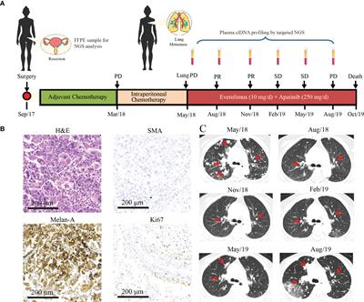 Uterine perivascular epithelioid tumors (PEComas) with lung metastasis showed good responses to mTOR and VEGFR inhibitors: A case report